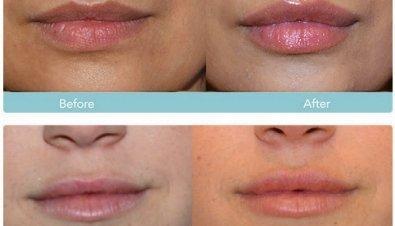 Dentures & Deflated Lips "How to Fix"