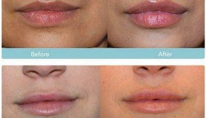 Dentures & Deflated Lips "How to Fix"
